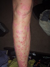 leg psoriasis before